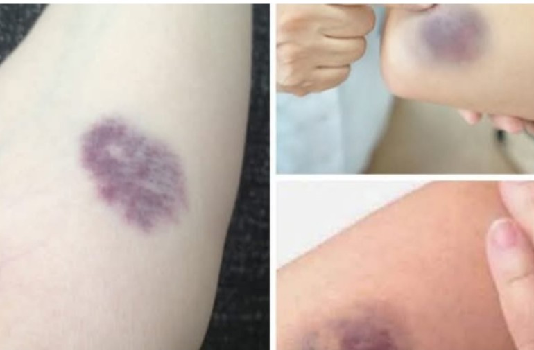 Understanding Bruises: Causes, Types, and Effective Treatments